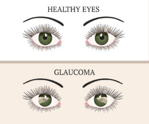 Elder Care in Southport IN: Dealing with Glaucoma